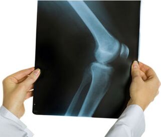 Raio X de artrose de joelho